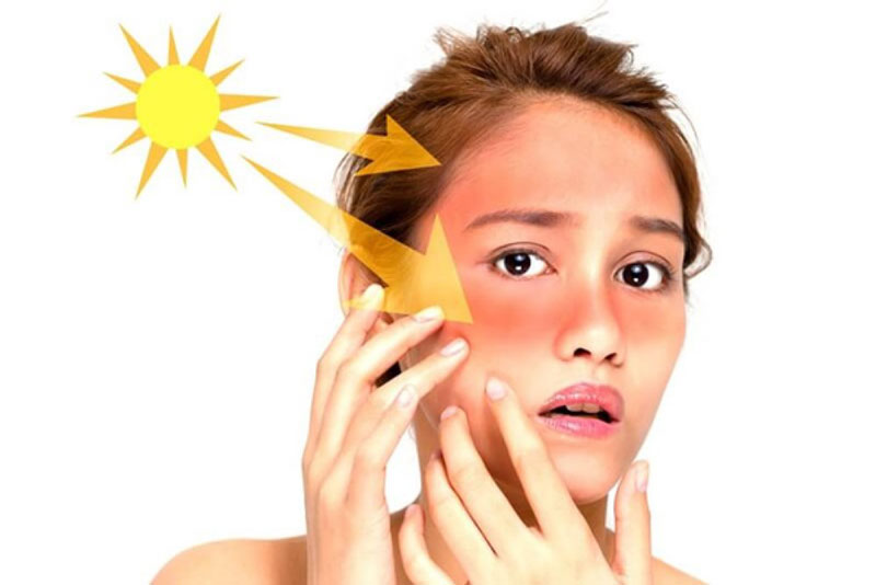 Tia cực tím trong ánh nắng mặt trời là yếu tố làm gia tăng nguy cơ mắc bệnh lupus ban đỏ
