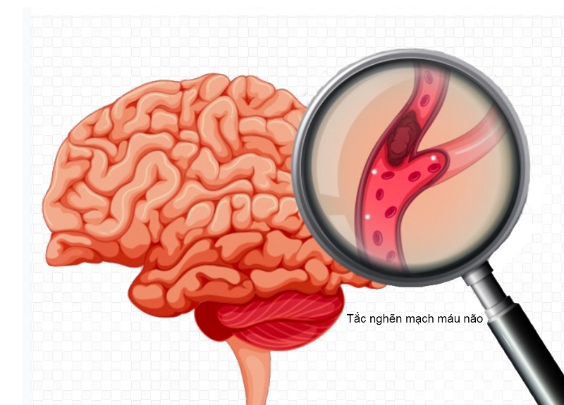 Thiếu máu não gây ra các ảnh hưởng tới hệ thần kinh trung ương