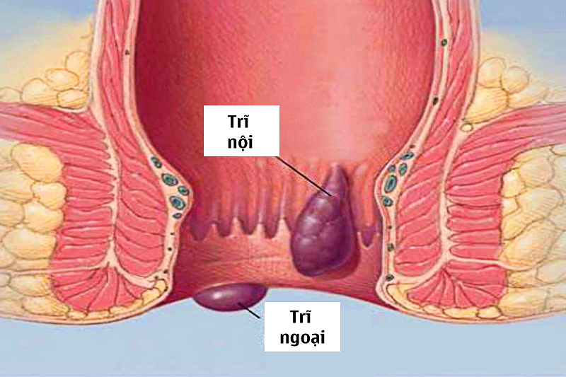 Trĩ nội và trĩ ngoại là hai loại bệnh thường gặp nhất