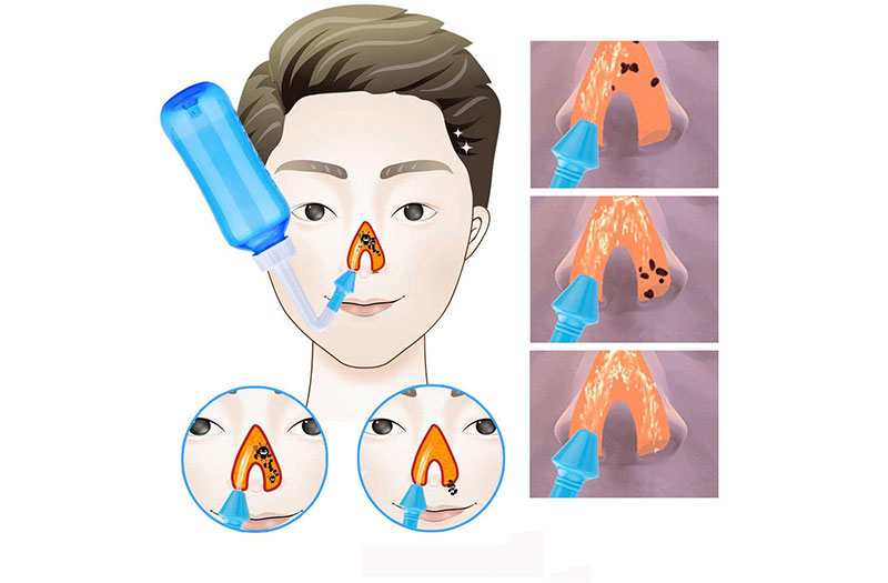 Hướng dẫn cách rửa mũi bằng nước muối sinh lý đúng kỹ thuật