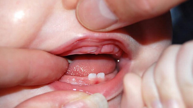 Mọc răng là một trong những nguyên nhân khiến trẻ dễ bị ngạt mũi về ban đêm