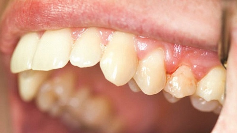 Viêm nha chu là tác nhân phổ biến nhất gây ra tình trạng răng bị lung lay