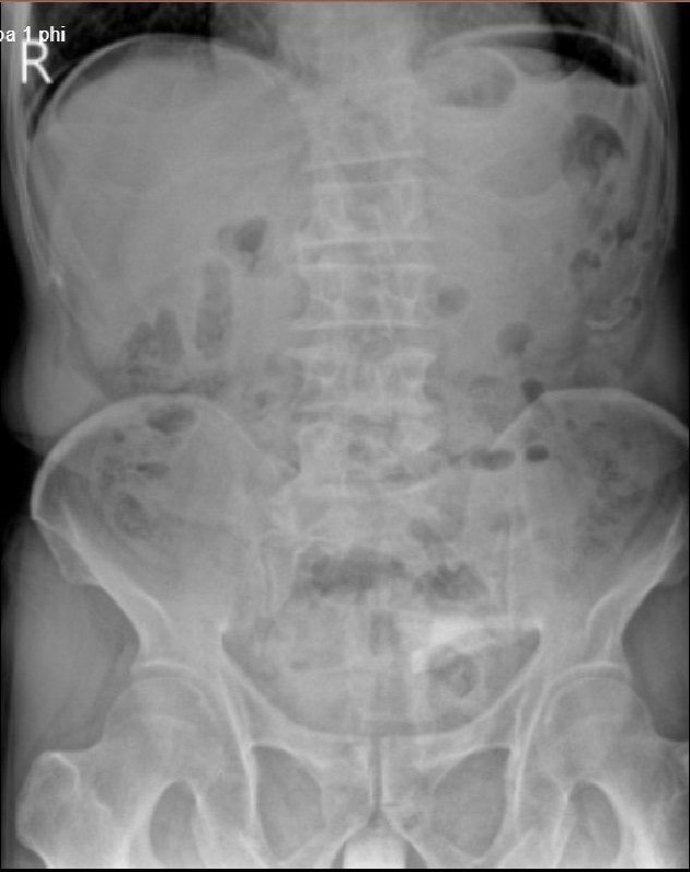 Hình ảnh chụp X-quang cho thấy bệnh nhân bị thủng tạng rỗng