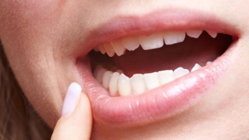 Nhiệt lưỡi thường do cắn vào lưỡi gây tổn thương