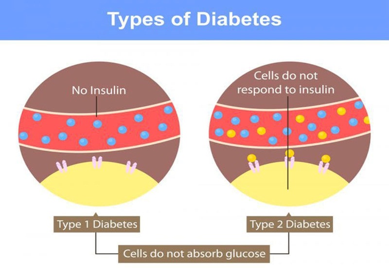 Bệnh tiểu đường được chia thành nhiều dạng khác nhau