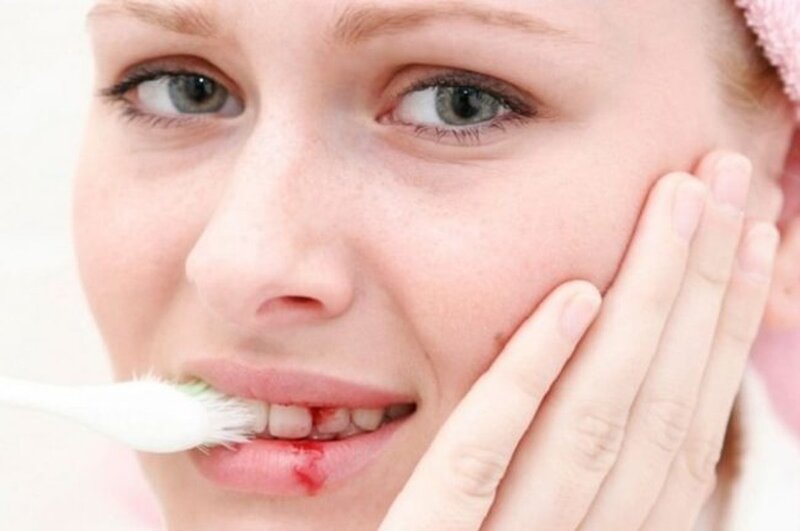 Chảy máu chân răng là dấu hiệu viêm lợi hoặc nhiều bệnh lý răng miệng khác