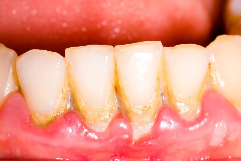 Cần loại bỏ cao răng ở các kẽ và chân răng để khắc phục chảy máu chân răng