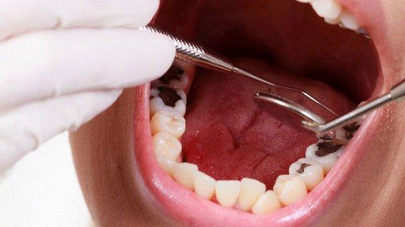  Răng khôn là răng khó vệ sinh và dễ bị sâu