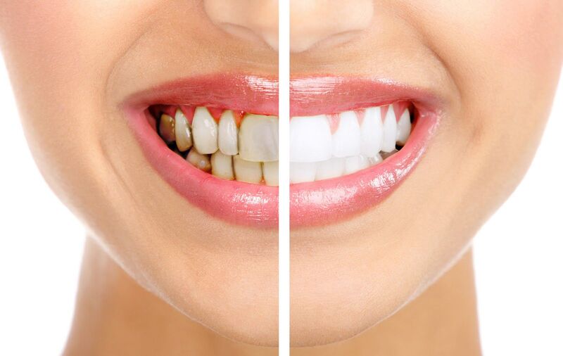 Tẩy trắng răng giúp bạn sở hữu hàm răng trắng sáng, đem lại sự tự tin
