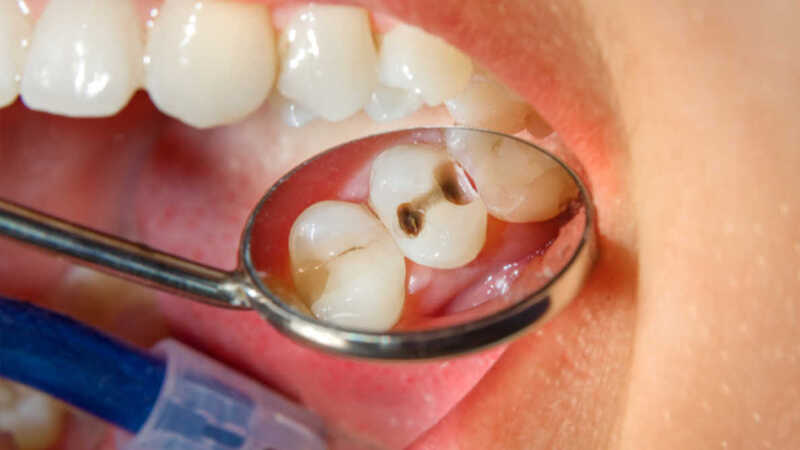  Viêm tủy răng không được điều trị có thể dẫn đến mất răng