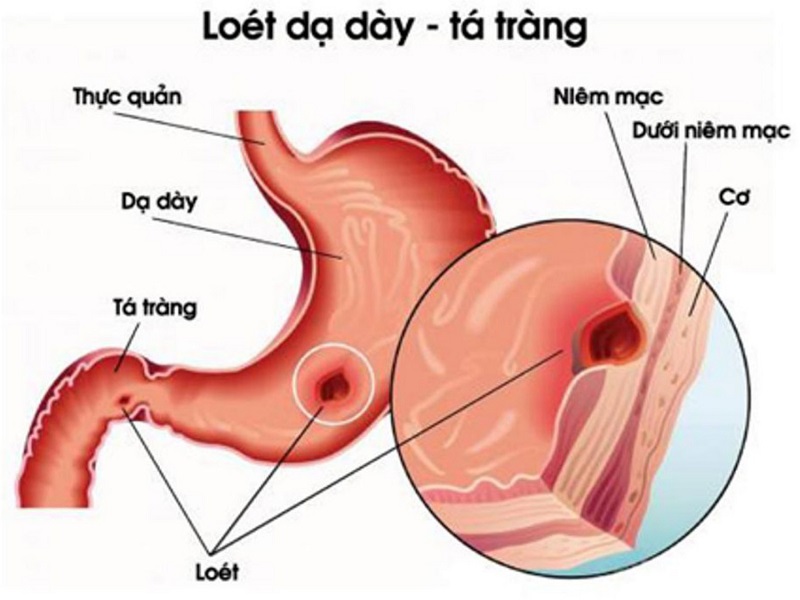 Tổn thương do viêm loét dạ dày gây nên hiện tượng đau bụng âm ỉ và tiêu chảy