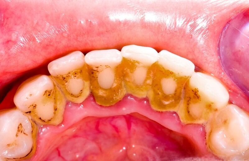 Cao răng hình thành từ quá trình vôi hóa cặn thức ăn thừa cùng vi khuẩn