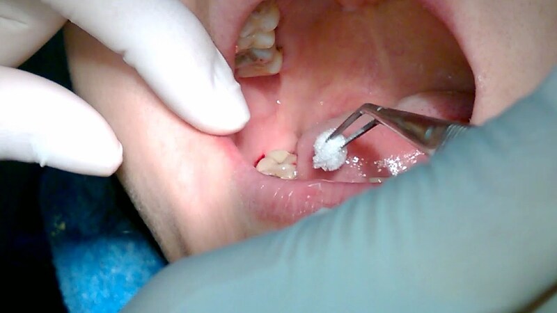 Răng khôn mọc lệch cần được chẩn đoán và điều trị