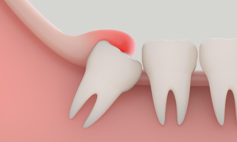Răng khôn mọc lệch thường gây viêm nướu, viêm chân răng
