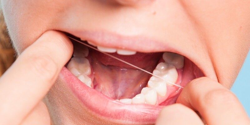 Răng khôn khó chăm sóc, vệ sinh nên dễ bị sâu răng