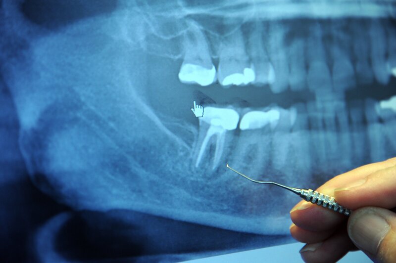 Phẫu thuật nhổ răng khôn khá đơn giản và nhanh chóng