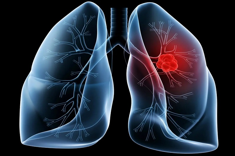 Phổi bị ứ nước do nhiều nguyên nhân, thường gặp nhất là viêm phổi, lao màng phổi,..