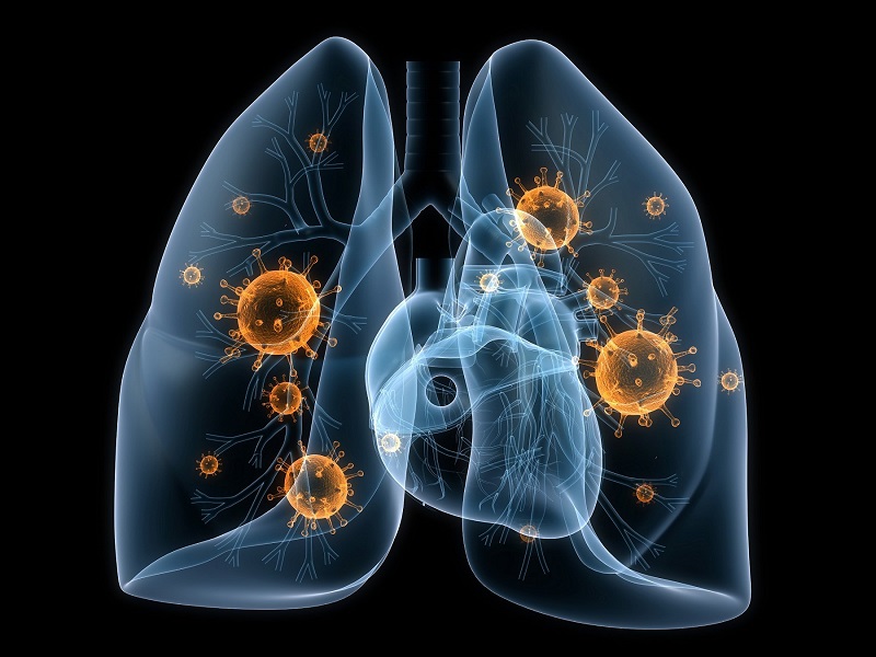 Các vấn đề về phổi có thể gây ra hội chứng suy hô hấp cấp tiến triển