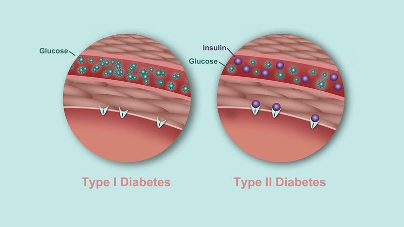 Khi mắc bệnh đái tháo đường type 2, cơ thể bệnh nhân vẫn sản sinh insulin