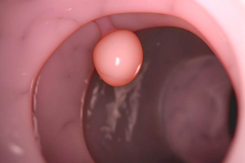 Polyp đại tràng sigma nằm ở đoạn cuối ống tiêu hóa