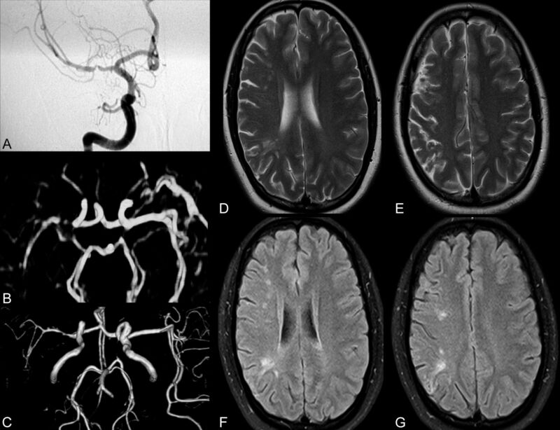 Chẩn đoán cơn thiếu máu não thoáng qua với thiết bị chụp MRI