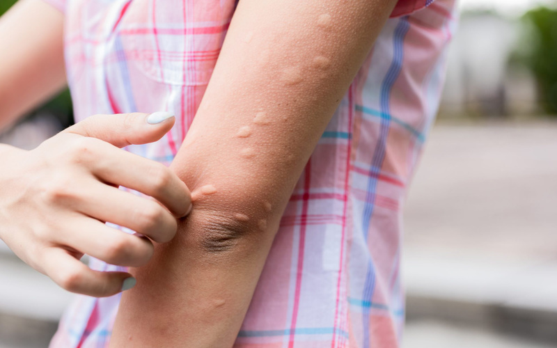  Nổi mề đay trên da rất thường gặp do nhiều nguyên nhân