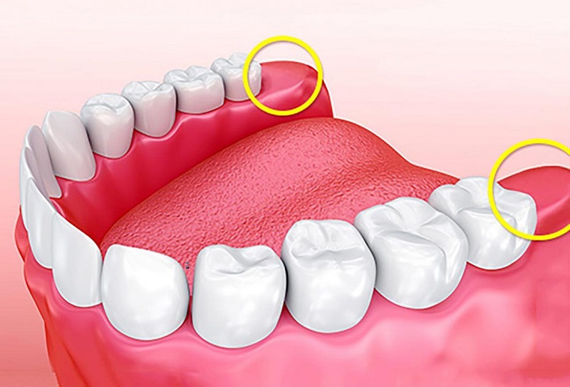 Vị trí mọc của răng khôn trên khung hàm