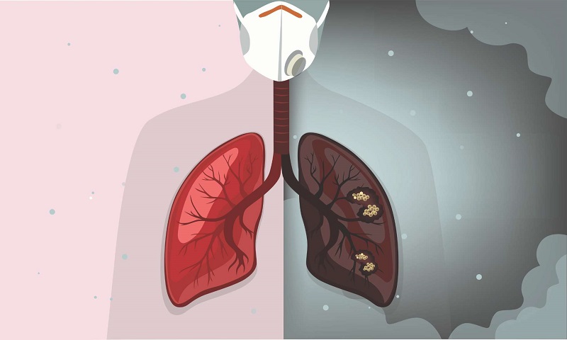 Ho nhiều có thể là dấu hiệu của ung thư phổi