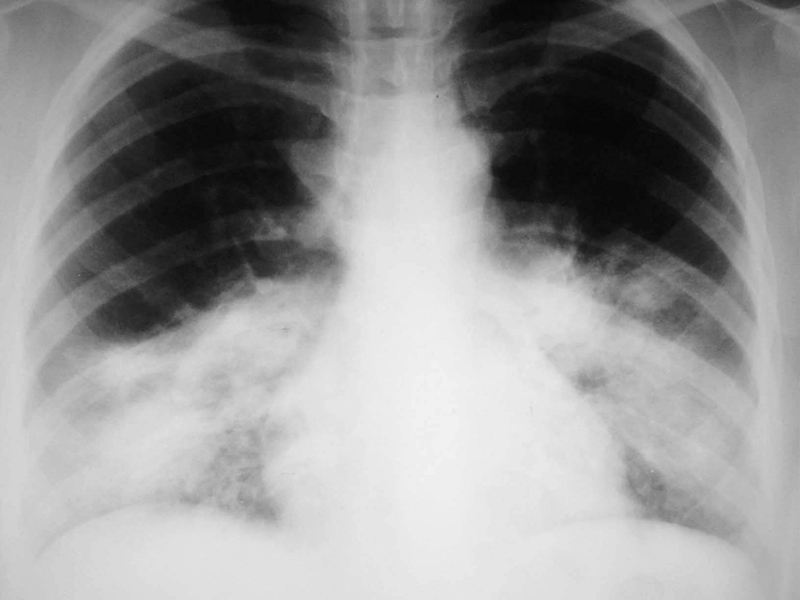 Có thể phát hiện viêm phổi không điển hình ở trẻ bằng cách chụp X-quang