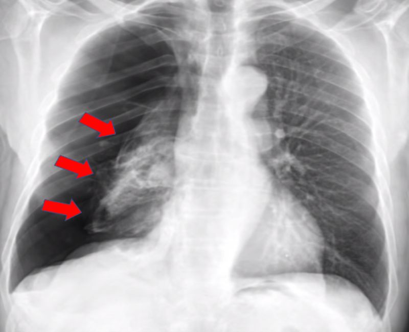 Sự tắc nghẽn hoặc chèn ép đường hô hấp có thể dẫn đến xẹp nhu mô phổi