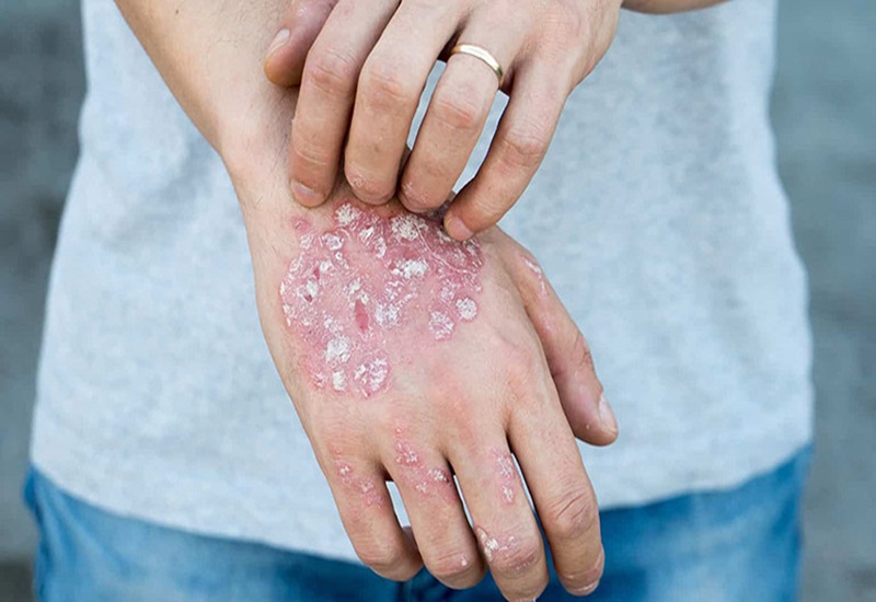 Chàm là bệnh ngoài da khá phổ biến