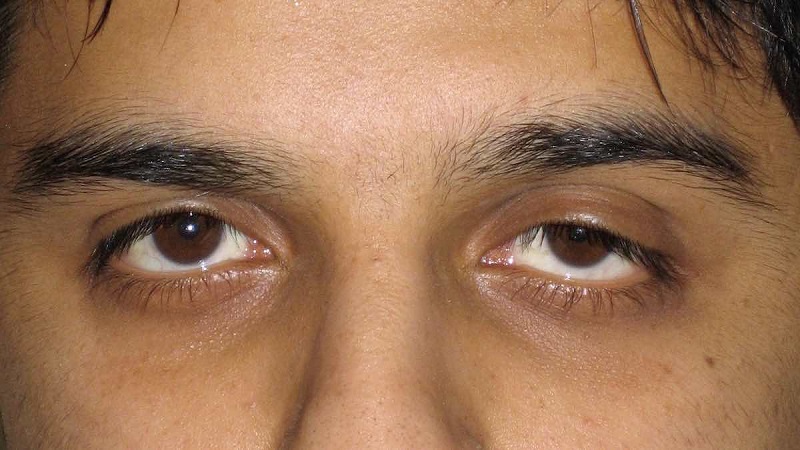 Sụp mí là một trong những bệnh lý phổ biến về mắt