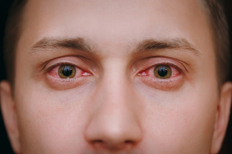Mắt bị đỏ, cộm có thể là triệu chứng của viêm giác mạc