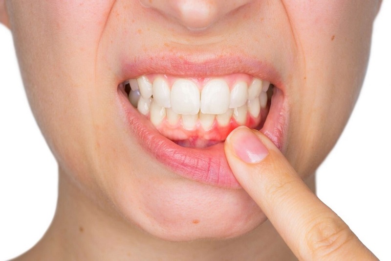 Bệnh ở nướu là nguyên nhân phổ biến gây đau răng