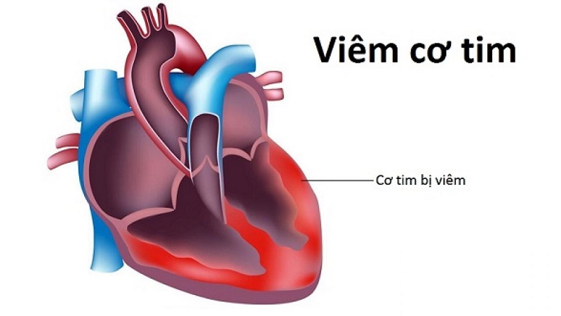 Viêm cơ tim là một trong các nguyên nhân khiến cho nhịp tim bị chậm