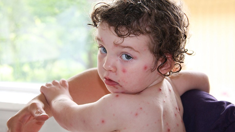 Thủy đậu là căn bệnh có đặc tính lây lan nhanh, chủ yếu xảy ra ở trẻ nhỏ