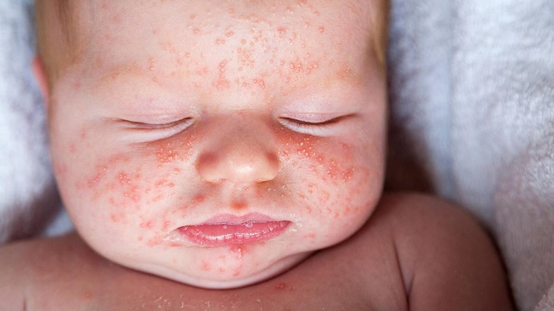 Trẻ sơ sinh là đối tượng hay mắc chàm da