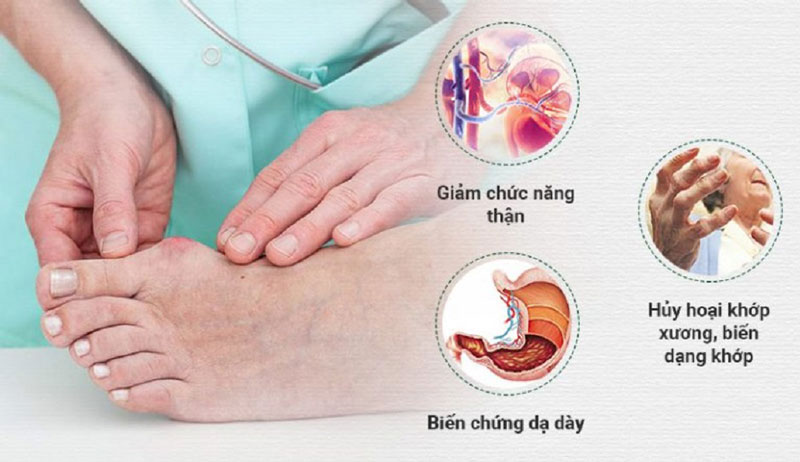 Gout rất nguy hiểm nếu như không phát hiện và điều trị bệnh gout kịp thời