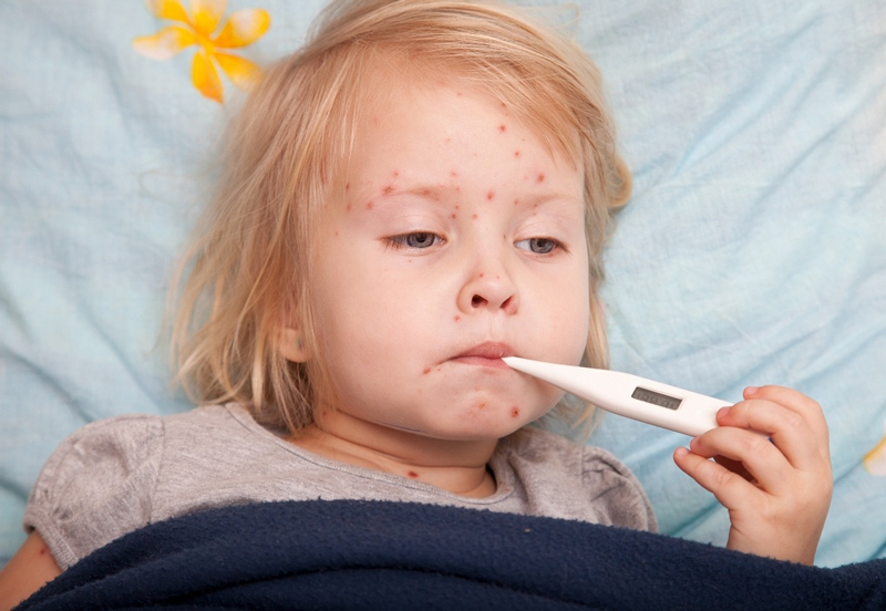 Bị thủy đậu và sốt cao nên uống thuốc hạ sốt để tránh biến chứng co giật, đặc biệt nguy hiểm ở trẻ em