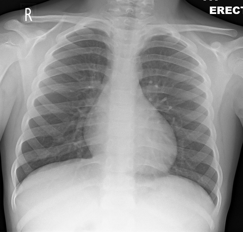 Chụp X-quang giúp phát hiện những tổn thương ở phổi