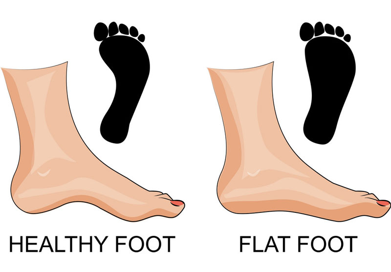 Hội chứng bàn chân bẹt thường gặp