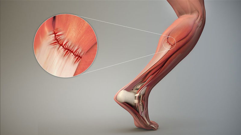 Hội chứng bắp chân căng xảy ra khá phổ biến