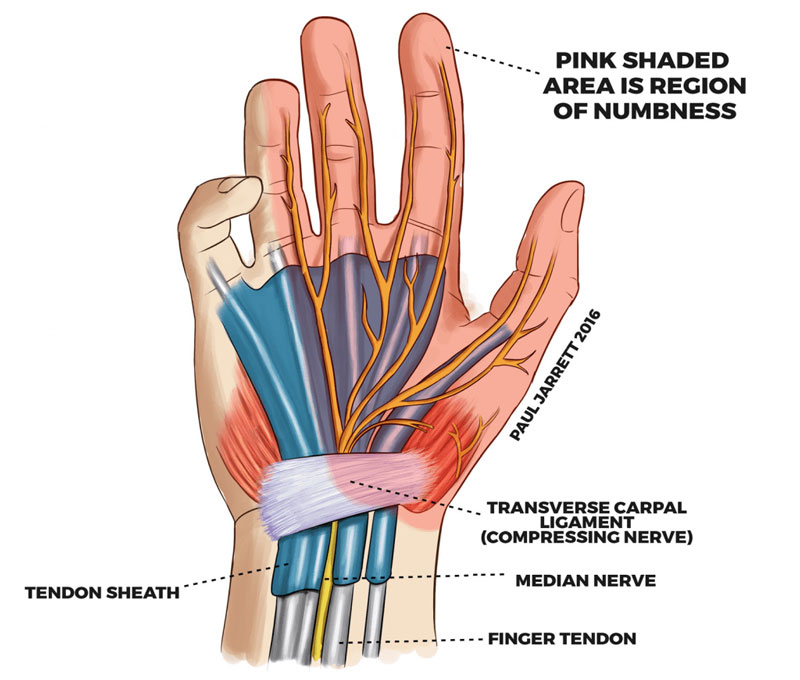 Hội chứng đường hầm cổ tay ảnh hưởng tới sinh hoạt hàng ngày của bạn