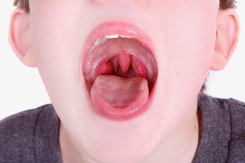 Viêm đường hô hấp cấp thường gây đau họng khó chịu