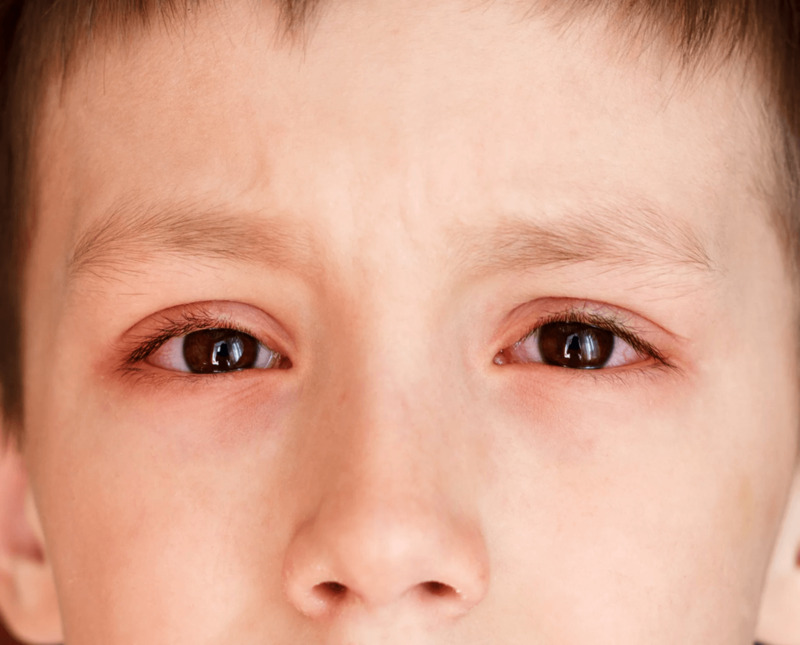 Đỏ mắt có thể ảnh hưởng đến khả năng nhìn của trẻ