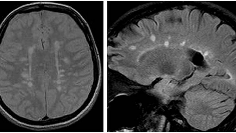 Hình ảnh chụp MRI cung cấp cơ sở để bác sĩ chẩn đoán và đưa ra hướng điều trị đa xơ cứng