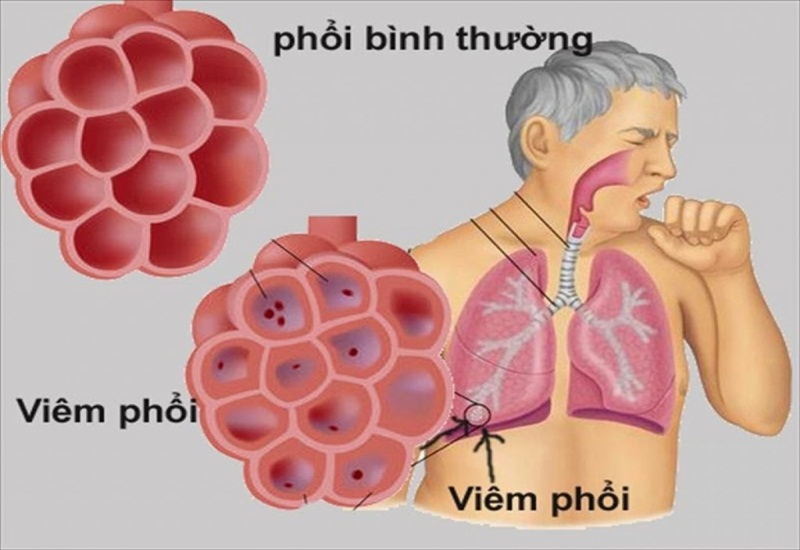 Viêm phổi có thể là nguyên nhân dẫn đến suy hô hấp