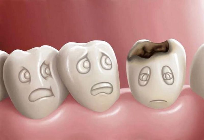 Răng sâu nếu không được xử lý sớm sẽ gây ra nhiều hệ lụy