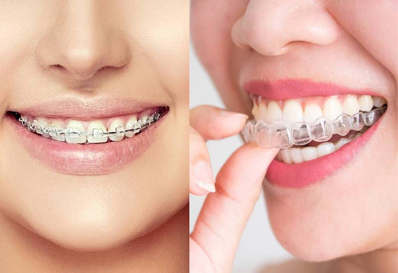 Khác biệt giữa niềng răng truyền thống (trái) và niềng răng invisalign (phải)
