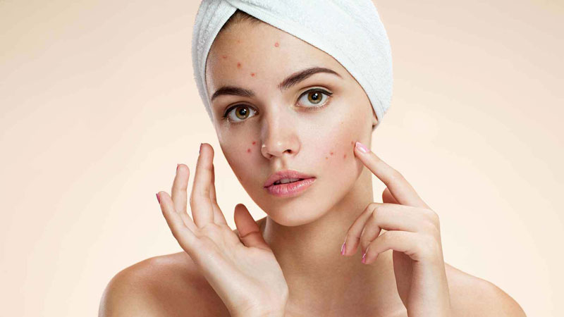 Chăm sóc da dầu mụn có khó không?